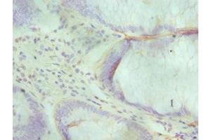 Immunohistochemistry of paraffin-embedded human colon cancer using ABIN7143716 at dilution of 1:100 (ALKBH1 Antikörper  (AA 110-389))