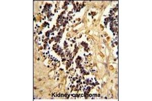 Formalin-fixed and paraffin-embedded human kidney carcinoma reacted with EHD3 Antibody (Center), which was peroxidase-conjugated to the secondary antibody, followed by DAB staining. (EHD3 Antikörper  (AA 189-216))