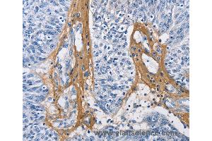 Immunohistochemistry of Human cervical cancer using COL3A1 Polyclonal Antibody at dilution of 1:60 (COL3A1 Antikörper)