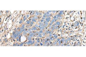 Immunohistochemistry of paraffin-embedded Human thyroid cancer tissue using PLA2G16 Polyclonal Antibody at dilution of 1:40(x200) (PLA2G16 Antikörper)