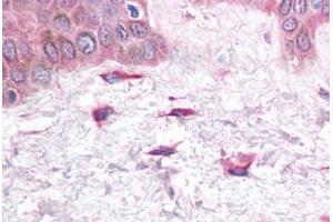 Human Skin, Fibroblasts (formalin-fixed, paraffin-embedded) stained with CXCL12 antibody ABIN214748 at 5 ug/ml followed by biotinylated goat anti-rabbit IgG secondary antibody ABIN481713, alkaline phosphatase-streptavidin and chromogen.