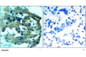 Immunohistochemical analysis of paraffin-embedded human lung carcinoma tissue using NF2 polyclonal antibody . (Merlin Antikörper)