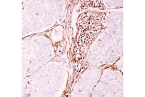 Immunohistochemical staining (Formalin-fixed paraffin-embedded sections) of human lung cancer tissue with ABCB1 polyclonal antibody  under 0. (ABCB1 Antikörper  (AA 621-650))