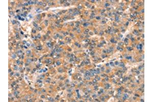 The image on the left is immunohistochemistry of paraffin-embedded Human liver cancer tissue using ABIN7189890(ARHGAP4 Antibody) at dilution 1/25, on the right is treated with synthetic peptide. (ARHGAP4 Antikörper)