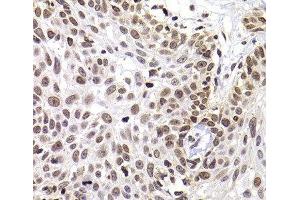 Immunohistochemistry of paraffin-embedded Human well-differentiated squamous skin carcinoma using PHIP Polyclonal Antibody at dilution of 1:100 (40x lens). (PHIP Antikörper)