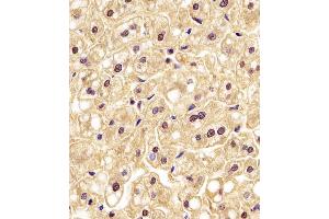 (ABIN6242522 and ABIN6577190) staining PGK1 in human liver tissue sections by Immunohistochemistry (IHC-P - paraformaldehyde-fixed, paraffin-embedded sections). (PGK1 Antikörper  (AA 1-417))