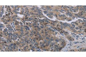 Immunohistochemistry of paraffin-embedded Human ovarian cancer tissue using NOX1 Polyclonal Antibody at dilution 1:50 (NOX1 Antikörper)