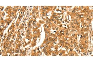 Immunohistochemistry of paraffin-embedded Human breast cancer tissue using DIRAS1 Polyclonal Antibody at dilution 1:52 (DIRAS1 Antikörper)