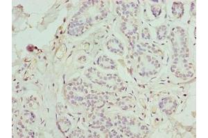 Immunohistochemistry of paraffin-embedded human breast cancer using ABIN7165550 at dilution of 1:100 (FAM71F1 Antikörper  (AA 121-343))