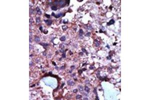 Formalin-fixed and paraffin-embedded human cancer tissue reacted with the primary antibody, which was peroxidase-conjugated to the secondary antibody, followed by AEC staining. (PKLR Antikörper  (N-Term))