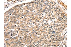 The image on the left is immunohistochemistry of paraffin-embedded Human lung cancer tissue using ABIN7191289(LONP1 Antibody) at dilution 1/25, on the right is treated with synthetic peptide. (LONP1 Antikörper)