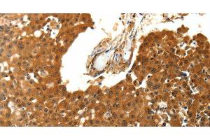 Immunohistochemistry of paraffin-embedded Human breast cancer using SKP1 Polyclonal Antibody at dilution of 1:30 (SKP1 Antikörper)