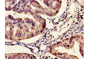 Immunohistochemistry of paraffin-embedded human endometrial cancer using ABIN7161170 at dilution of 1:100 (SYNE2 Antikörper  (AA 1-176))