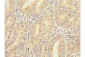 Immunohistochemistry of paraffin-embedded human endometrial cancer using ABIN7176401 at dilution of 1:100 (ZNF582 Antikörper  (AA 1-300))