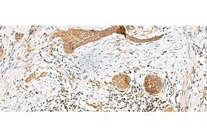 Immunohistochemistry of paraffin-embedded Human esophagus cancer tissue using GSTM2 Polyclonal Antibody at dilution of 1:50(x200) (GSTM2 Antikörper)