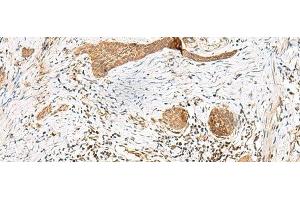 Immunohistochemistry of paraffin-embedded Human esophagus cancer tissue using GSTM2 Polyclonal Antibody at dilution of 1:50(x200)