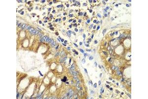 Immunohistochemistry of paraffin-embedded Human colon using PICK1 Polyclonal Antibody at dilution of 1:100 (40x lens). (PICK1 Antikörper)
