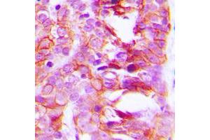 Immunohistochemical analysis of KCNK15 staining in human breast cancer formalin fixed paraffin embedded tissue section.