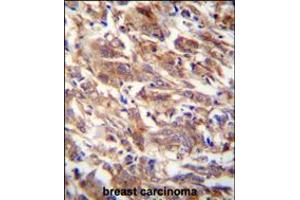FBXW12 antibody immunohistochemistry analysis in formalin fixed and paraffin embedded human breast carcinoma followed by peroxidase conjugation of the secondary antibody and DAB staining. (FBXW12 Antikörper  (C-Term))