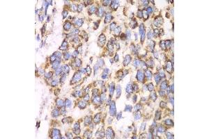 Immunohistochemistry of paraffin-embedded human esophageal cancer using ATP5A1 antibody.