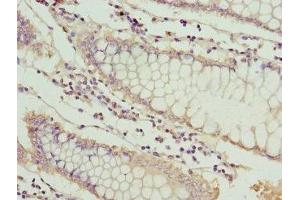 Immunohistochemistry of paraffin-embedded human colon cancer using ABIN7159525 at dilution of 1: 100 (MT1G Antikörper  (AA 1-59))