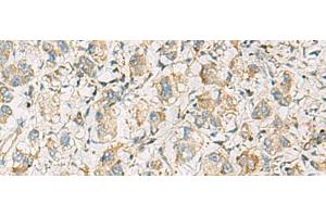 Immunohistochemistry of paraffin-embedded Human liver cancer tissue using PDE4DIP Polyclonal Antibody at dilution of 1:60(x200)