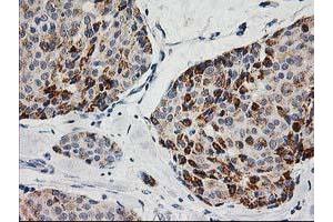 Immunohistochemical staining of paraffin-embedded Adenocarcinoma of Human breast tissue using anti-AK4 mouse monoclonal antibody. (AK4 Antikörper)