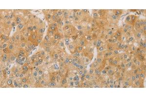 Immunohistochemistry of paraffin-embedded Human liver cancer using ACSL4 Polyclonal Antibody at dilution of 1:60