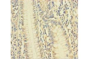 Immunohistochemistry of paraffin-embedded human colon cancer using ABIN7175481 at dilution of 1:100 (VAMP5 Antikörper  (AA 1-72))