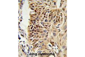 CIRBP Antibody (C-term) IHC analysis in formalin fixed and paraffin embedded human lung carcinoma followed by peroxidase conjugation of the secondary antibody and DAB staining. (CIRBP Antikörper  (C-Term))
