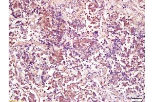 Formalin-fixed and paraffin embedded human lung carcinoma labeled with Anti-PP2A alpha + beta Polyclonal Antibody, Unconjugated (ABIN723875) at 1:200 followed by conjugation to the secondary antibody and DAB staining