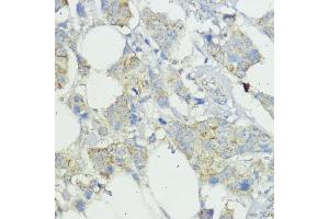 Immunohistochemistry of paraffin-embedded human mammary cancer using SOCS6 antibody (ABIN6128785, ABIN6148273, ABIN6148274 and ABIN6225294) at dilution of 1:100 (40x lens). (SOCS6 Antikörper  (AA 1-210))