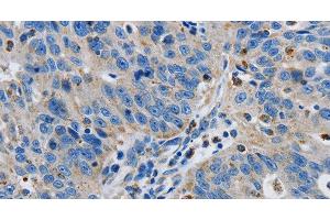 Immunohistochemistry of paraffin-embedded Human ovarian cancer tissue using GRIA3 Polyclonal Antibody at dilution 1:50 (Glutamate Receptor 3 Antikörper)