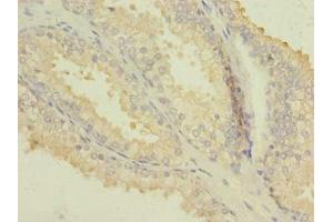 Immunohistochemistry of paraffin-embedded human prostate cancer using ABIN7163163 at dilution of 1:100 (PIK3R1 Antikörper  (Regulatory Subunit A))