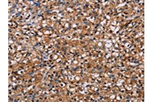The image on the left is immunohistochemistry of paraffin-embedded Human prostate cancer tissue using ABIN7130450(NPM3 Antibody) at dilution 1/60, on the right is treated with fusion protein. (NPM3 Antikörper)