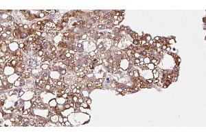 ABIN6272902 at 1/100 staining Human liver cancer tissue by IHC-P. (MPP5 Antikörper  (C-Term))