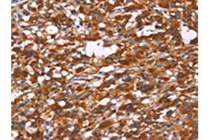 The image on the left is immunohistochemistry of paraffin-embedded Human thyroid cancer tissue using ABIN7190842(GPHN Antibody) at dilution 1/30, on the right is treated with synthetic peptide. (Gephyrin Antikörper)