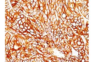 Formalin-fixed, paraffin-embedded human Colon Carcinoma stained with Cytokeratin 18 Mouse Monoclonal Antibody (DA7). (Cytokeratin 18 Antikörper)