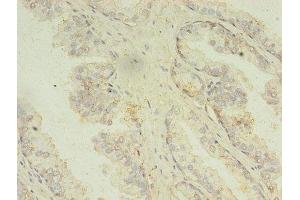 Immunohistochemistry of paraffin-embedded human prostate cancer using ABIN7159988 at dilution of 1:100 (MAPK13 Antikörper  (AA 1-365))