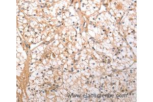 Immunohistochemistry of Human lung cancer using HCRTR1 Polyclonal Antibody at dilution of 1:100 (HCRTR1 Antikörper)