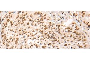 Immunohistochemistry of paraffin-embedded Human lung cancer tissue using HOXA7 Polyclonal Antibody at dilution of 1:70(x200) (HOXA7 Antikörper)