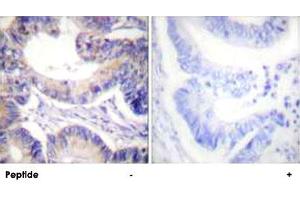 Immunohistochemical analysis of paraffin-embedded human colon carcinoma tissue using ACACA polyclonal antibody . (Acetyl-CoA Carboxylase alpha Antikörper  (Ser80))