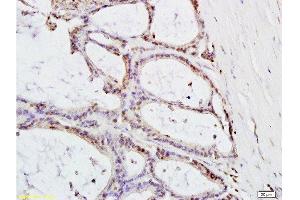 Formalin-fixed and paraffin embedded: human colon carcinoma labeled with Anti-MTLC Polyclonal Antibody , Unconjugated at 1:200, followed by conjugation to the secondary antibody and DAB staining (Myc Target 1 Antikörper  (AA 21-100))