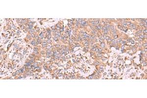 Immunohistochemistry of paraffin-embedded Human ovarian cancer tissue using EEF1D Polyclonal Antibody at dilution of 1:65(x200) (EEF1D Antikörper)