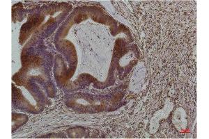Immunohistochemistry (IHC) analysis of paraffin-embedded Human Colon Carcinoma using Smad3 Mouse Monoclonal Antibody diluted at 1:200. (SMAD3 Antikörper)