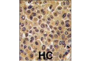 Formalin-fixed and paraffin-embedded human breast carcinoma tissue reacted with CDC25B antibody (Center), which was peroxidase-conjugated to the secondary antibody, followed by DAB staining. (CDC25B Antikörper  (AA 331-360))