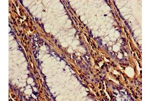 Immunohistochemistry of paraffin-embedded human colon cancer using ABIN7148987 at dilution of 1:100 (CSTB Antikörper  (AA 1-98))