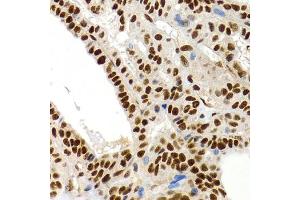 Immunohistochemistry of paraffin-embedded human thyroid cancer using MT2A antibody (ABIN1873764) at dilution of 1:200 (40x lens). (MT2A Antikörper)