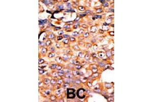 Formalin-fixed and paraffin-embedded human cancer tissue reacted with PANK3 polyclonal antibody  , which was peroxidase-conjugated to the secondary antibody, followed by AEC staining.