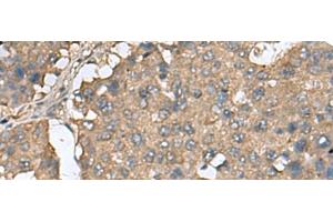 Immunohistochemistry of paraffin-embedded Human liver cancer tissue using EIF4A2 Polyclonal Antibody at dilution of 1:65(x200) (EIF4A2 Antikörper)